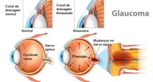 melhor-tratamento-glaucoma
