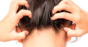 caspas-psoriase-couro-cabeludo