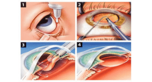 lentes-instraoculares-cirurgia-catarata