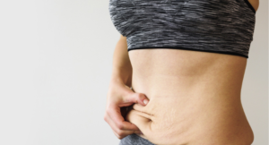 flacidez-abdominal
