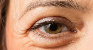 plastica-ocular-blefaroplastia