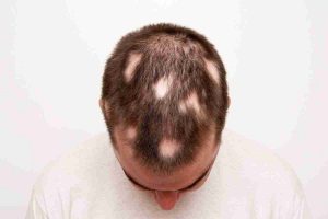 alopecia-areata
