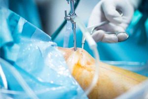cirurgia-de-joelho-em-goiania