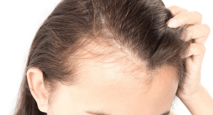 alopecia-frontal-fibrosante-doenca-mais-comum